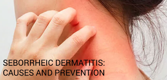 Seborrheic Dermatitis